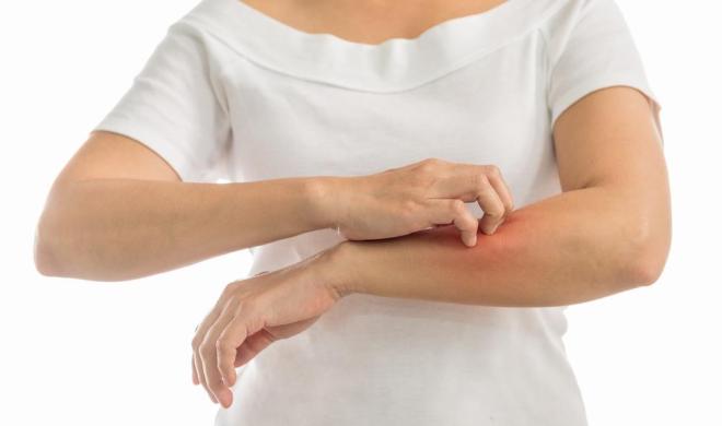 Tips Mengatasi Penyakit Kulit Vitiligo