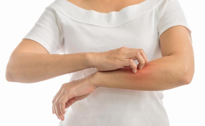 Tips Mengatasi Penyakit Kulit Vitiligo